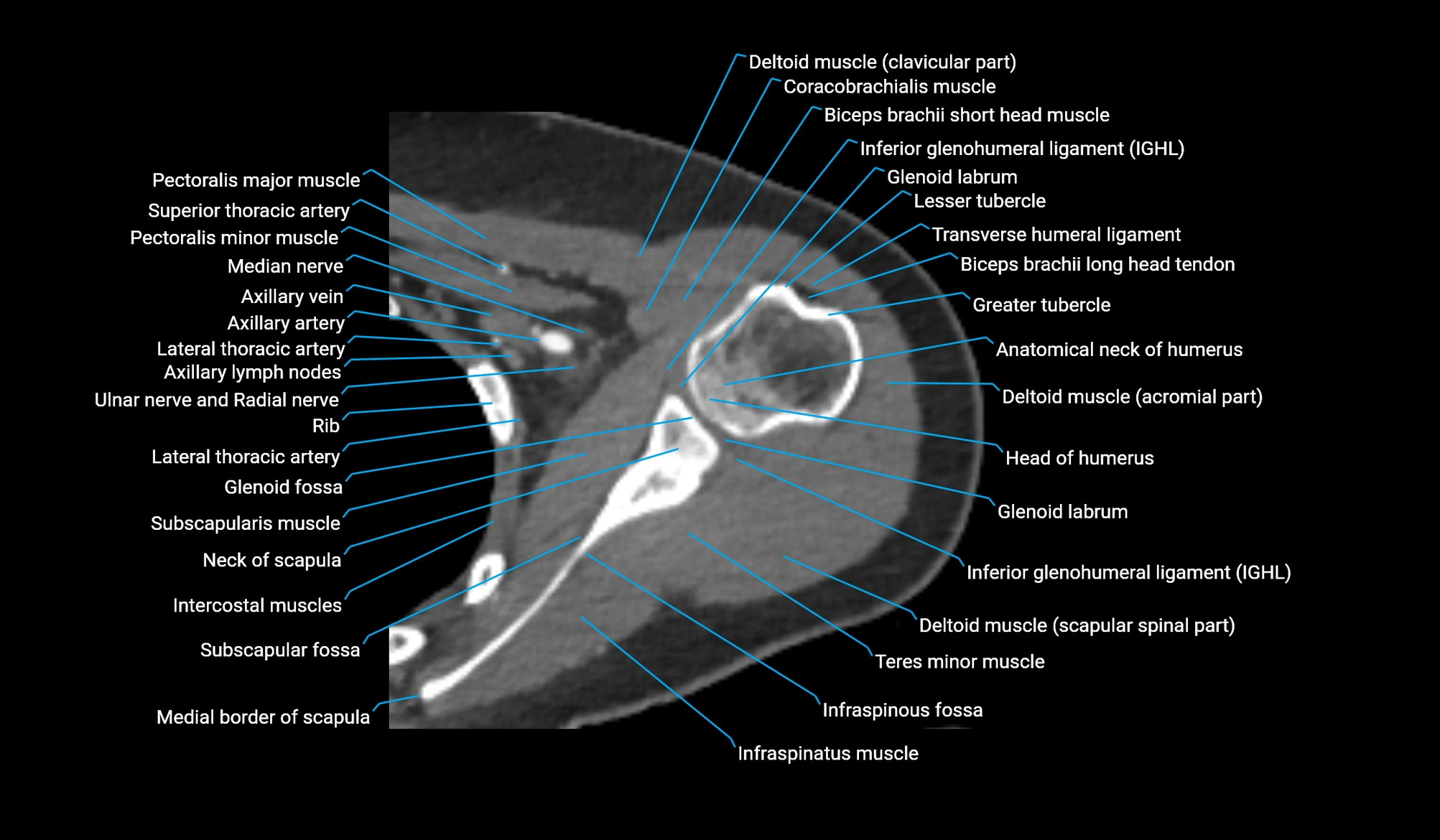 CT upper arm axial  cross sectional anatomy labelled radiology image -00106.webp